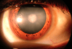 Cataracts - Symptoms and causes